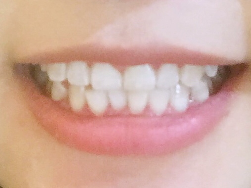 安慶渡江口腔醫(yī)院張良斌醫(yī)生做超聲波洗牙效果怎么樣？附洗牙案例效果圖