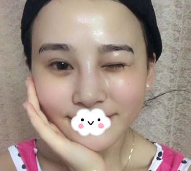 蚌埠韓美美萊整形醫(yī)生歷芳做耳軟骨隆鼻怎么樣？附耳軟骨隆鼻案例對比圖