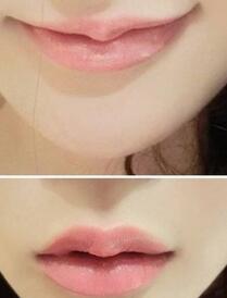 巴中時光醫(yī)學美容門診部做玻尿酸豐唇效果怎么樣？附李紅強豐唇案例