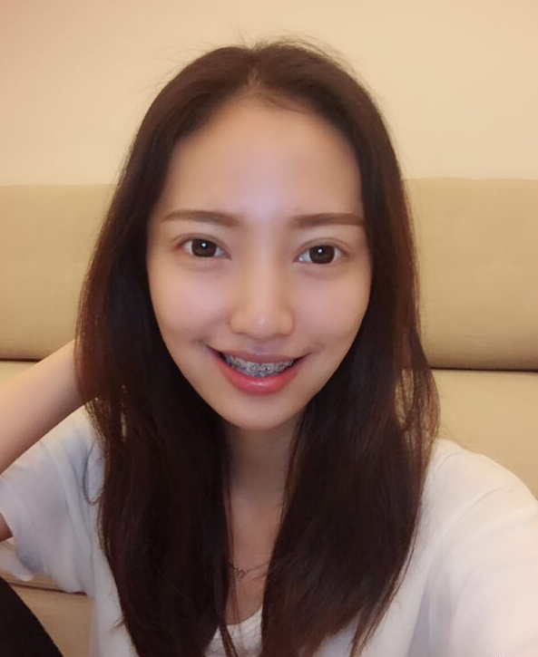 巴中華醫(yī)口腔醫(yī)院做牙齒矯正效果好嗎？附母汶靈醫(yī)生牙齒矯正案例效果圖