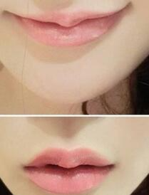 巴中時光醫(yī)學(xué)美容門診部做玻尿酸豐唇效果怎么樣？附李紅強豐唇案例