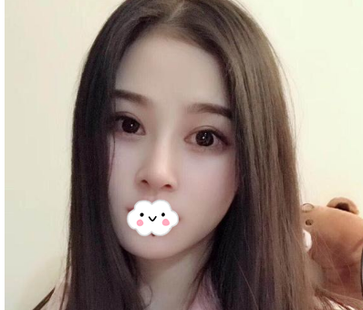 蚌埠韓美美萊整形醫(yī)生歷芳做耳軟骨隆鼻怎么樣？附耳軟骨隆鼻案例對比圖