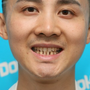 鞍山時(shí)代口腔門診部做瓷貼面怎么樣？附孫興國(guó)醫(yī)生瓷貼面案例效果圖