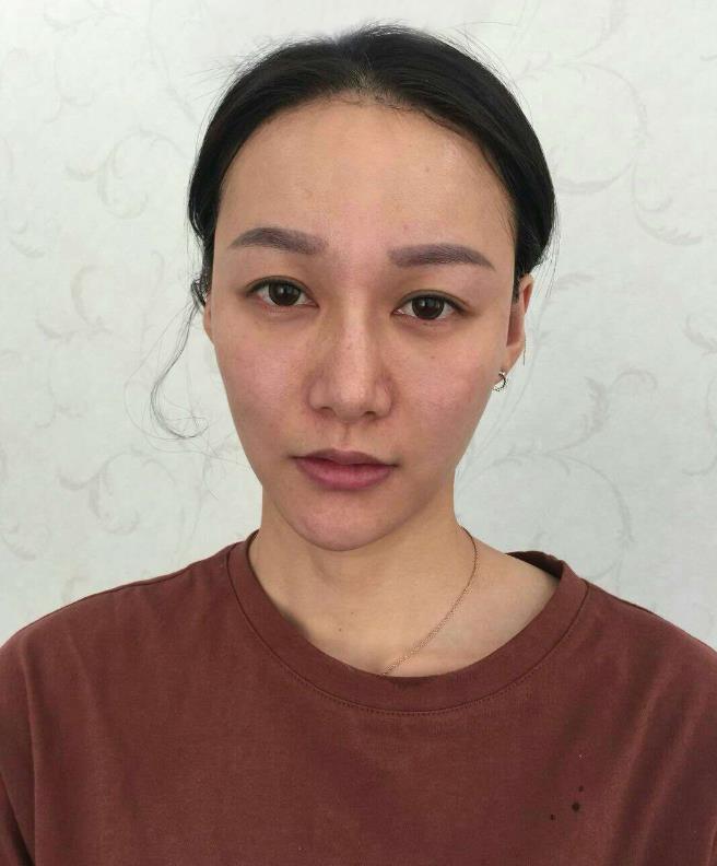 鞍山王景醫(yī)療美容外科診所做光子嫩膚怎么樣？附王景醫(yī)生案例效果圖