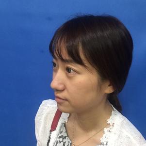 蚌埠韓美美萊整形做玻尿酸面部除皺效果怎么樣？附陳澤醫(yī)生案例效果圖
