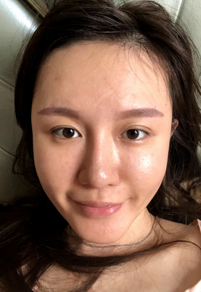 蚌埠韓美美萊整形醫(yī)生張燕做自體脂肪豐面頰效果怎么樣？附案例效果圖