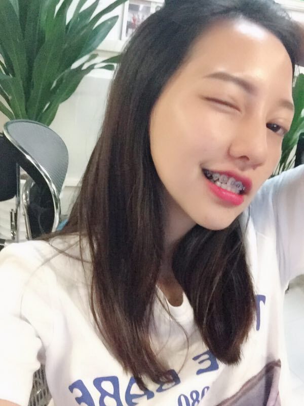巴中華醫(yī)口腔醫(yī)院做牙齒矯正效果好嗎？附母汶靈醫(yī)生牙齒矯正案例效果圖