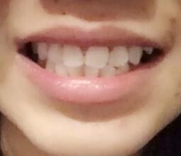 鞍山時代口腔門診部劉昕醫(yī)生做美容冠效果怎么樣？一起來看看吧