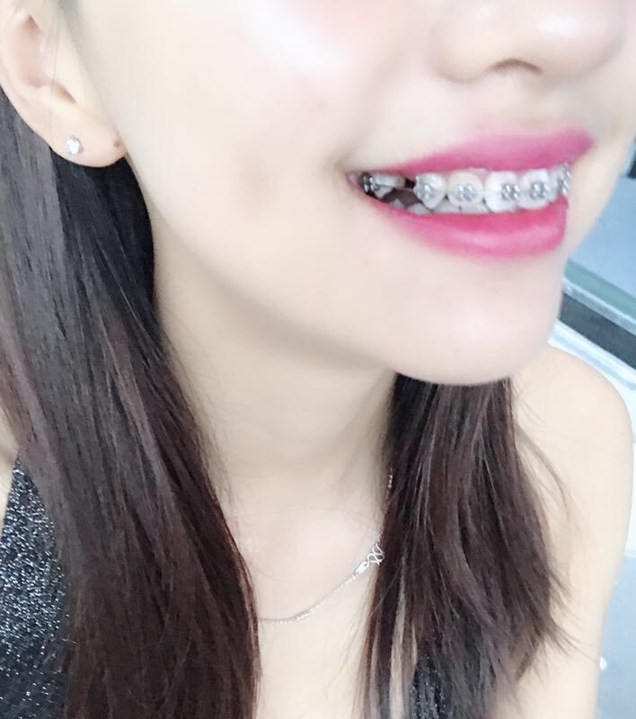 巴中華醫(yī)口腔醫(yī)院做牙齒矯正效果好嗎？附母汶靈醫(yī)生牙齒矯正案例效果圖