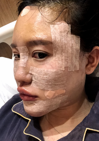 蚌埠韓美美萊整形醫(yī)生張燕做自體脂肪豐面頰效果怎么樣？附案例效果圖