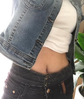 保定現(xiàn)代女子醫(yī)院整形美容中心做腰腹部吸脂怎么樣？附林秀蓮醫(yī)生案例效果圖