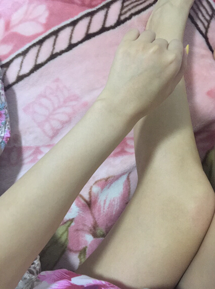 蚌埠市第三人民醫(yī)院燒傷整形科李方奇注射美白針效果怎么樣？安全嗎？附案例