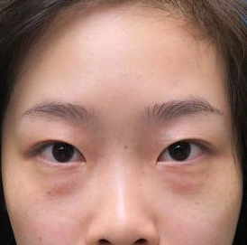 保定安卓貝拉醫(yī)療美容門診部孫大山醫(yī)生做雙眼皮+去眼袋怎么樣？附案例效果對比圖