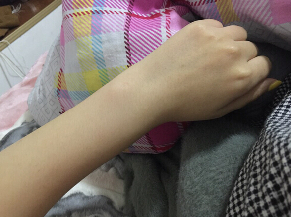 蚌埠市第三人民醫(yī)院燒傷整形科李方奇注射美白針效果怎么樣？安全嗎？附案例
