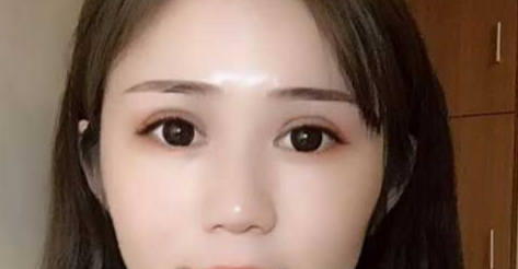 全切雙眼皮消腫的辦法有哪些？