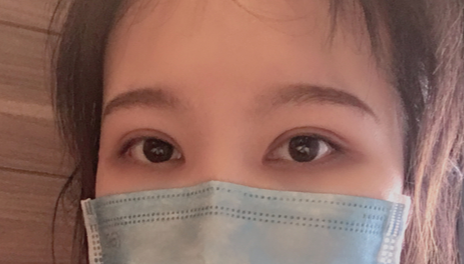 全切雙眼皮會(huì)越來(lái)越窄嗎？