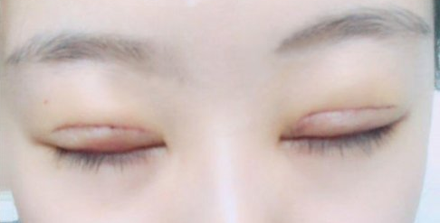 全切雙眼皮術(shù)后會(huì)留疤嗎？