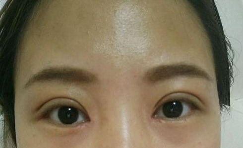 全切雙眼皮術(shù)后會留疤嗎？