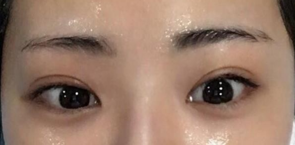 雙眼皮全切的風(fēng)險(xiǎn)有哪些？