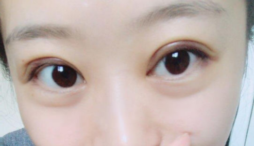 全切雙眼皮手術時間？全切雙眼皮術后會反彈嗎？