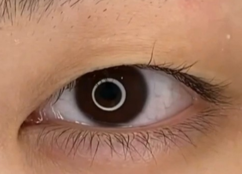 全切雙眼皮幾天可以洗臉？