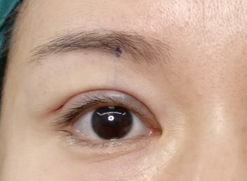 全切雙眼皮會消失嗎？全切雙眼皮多久定型？