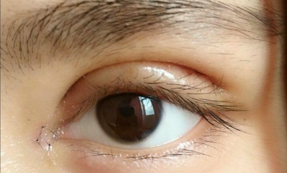 全切雙眼皮會(huì)留疤嗎？全切雙眼皮的優(yōu)缺點(diǎn)？