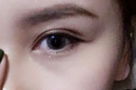 全切雙眼皮多久恢復(fù)好可以看到效果？全切雙眼皮需要多少錢？
