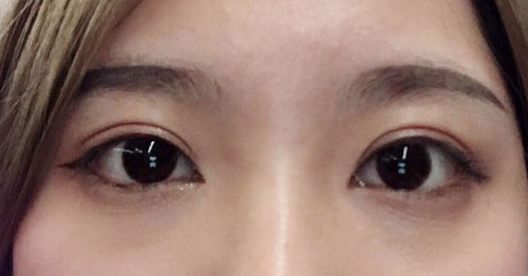 埋線雙眼皮幾天可以碰水？埋線雙眼皮有哪些注意事項？