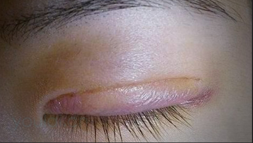埋線雙眼皮一般會(huì)腫幾天？