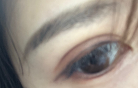 埋線雙眼皮疼嗎？埋線雙眼皮手術(shù)優(yōu)勢(shì)有哪些？