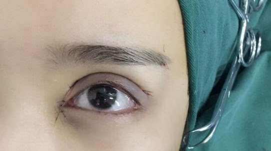埋線雙眼皮會(huì)不會(huì)脫線？
