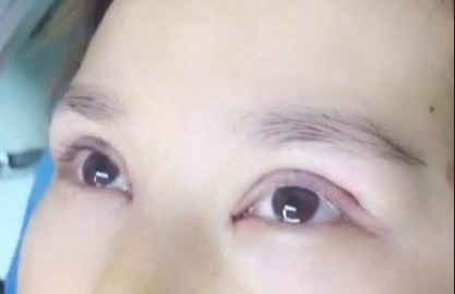 埋線雙眼皮有哪些注意事項(xiàng)？