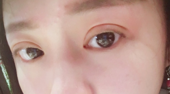 埋線雙眼皮可以保持幾年？埋線雙眼皮的危害有哪些？