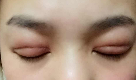 埋線雙眼皮幾天能消腫？