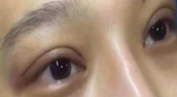 埋線雙眼皮大概能保持幾年??？埋線雙眼皮需要拆線嗎？