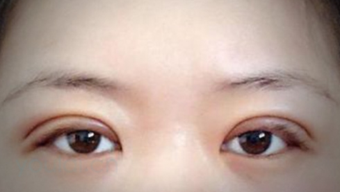 定點(diǎn)雙眼皮幾天能恢復(fù)好？定點(diǎn)做雙眼皮多少錢？