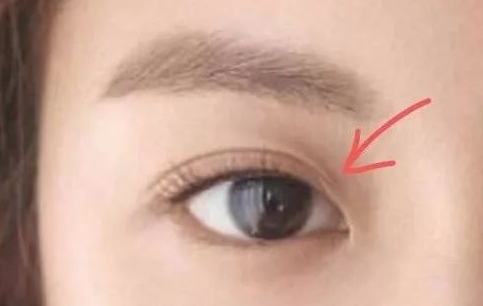 定點(diǎn)雙眼皮多久可以化妝？定點(diǎn)雙眼皮一般多少錢？