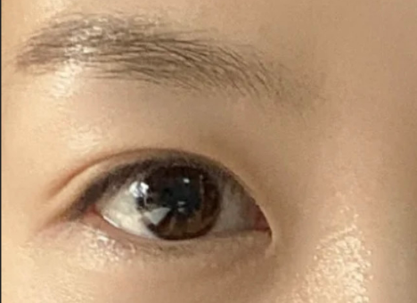 割雙眼皮后自然嗎？