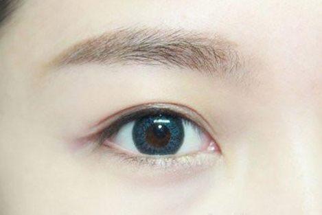 割雙眼皮幾個月定型？