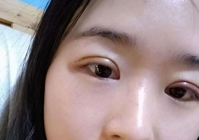 割雙眼皮后眼睛會變大嗎？