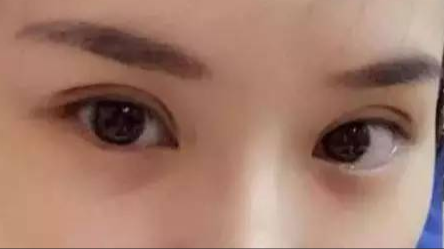 做雙眼皮對身體有沒有危害？