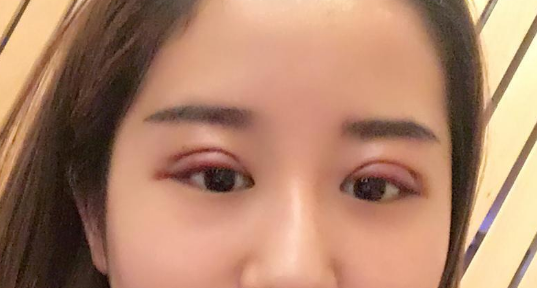 做雙眼皮大概多少錢？做雙眼皮拆線疼嗎？