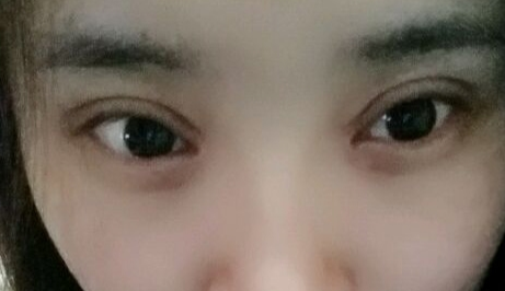 開(kāi)眼角疼嗎？開(kāi)眼角術(shù)后會(huì)留疤的原因有哪些？
