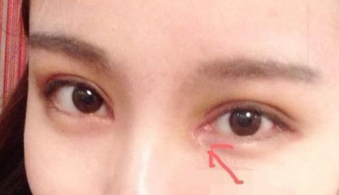 單眼皮開內(nèi)眼角會留疤嗎？