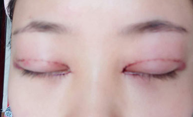 韓式開眼角手術(shù)有哪些優(yōu)勢？開眼角手術(shù)有哪些優(yōu)勢？
