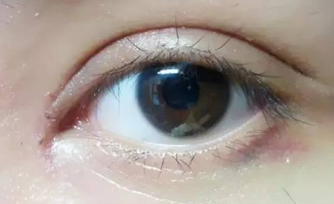 韓式開(kāi)眼角好嗎？韓式開(kāi)眼角術(shù)后怎么護(hù)理？
