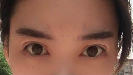 韓式開眼角的有副作用嗎？