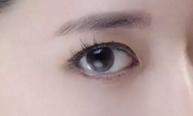 韓式開眼角的手術(shù)費(fèi)用是多少？