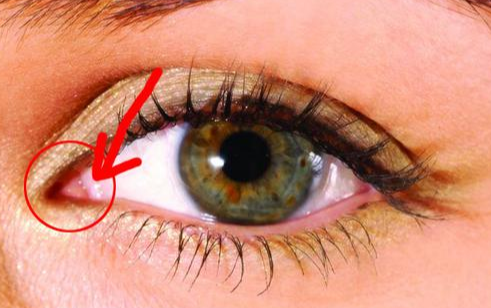 開內(nèi)眼角手術(shù)有什么效果？術(shù)后有哪些注意事項？